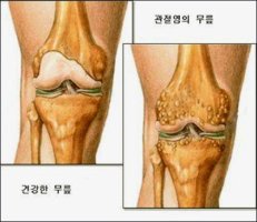 퇴행성관절염 증상과 원인