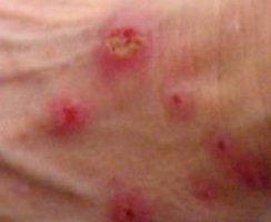 Morgellons Disease