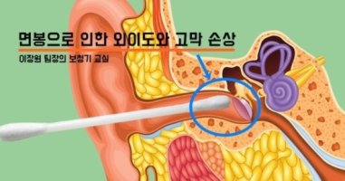 샤워 후 면봉으로 귀파면 안되는 이유