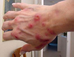 sindrome di morgellons