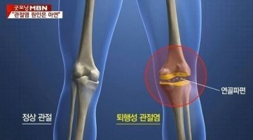 퇴행성 관절염