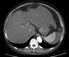 간경화 초기 증상과 좋은 음식