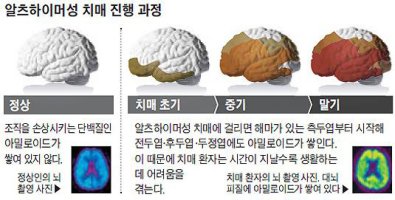 치매(알츠하이머병)의 경과와 예후, 관리법