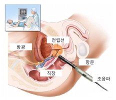 전립선암 초기 증상과 치료 예방법