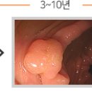 힘든 내시경·불편한 대변 채취, 안해도 된다?···“대장암 진단, 피만 뽑아도 정확도 높아” 이미지