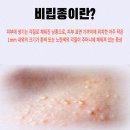 내가 하는 스스로 정리법 | 이마 비립종 제거 셀프압출 후기, 눈 까지 정리