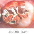 의료장비 - 인레이 이미지