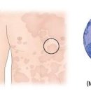 피부 곰팡이균 원인 피부 어루러기 증상 예방 치료 종류 이미지