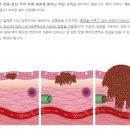 악성신생물과 양성신생물, 왜 보상이 다를까? 이미지