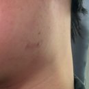 (아르페 트러블케어 엑스퍼트 마이크로니들 패치)속드름 관리, 내가 직접 써보고 붙여본 리얼 후기