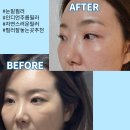 바보디자인거리 | [강남역피부과] 눈밑필러, 인디언 주름필러 전후, 후기, 붓기, 통증, 부작용