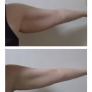 예신관리 팔뚝 다이어트 시술 한달 후기 및 스튜디오 촬영