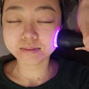 남양주다산피부과 여름오기전 모공관리 피코프락셀 2회차 후기
