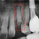 수원탑플란트치과의원 | 영통역 치과, 발치 후 즉시 임플란트 식립 케이스[수원탑플란트치과의원]