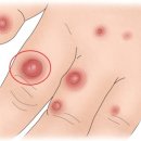 접촉 피부염Contact dermatitis피부질환 이미지