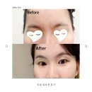 삼성의료가스 | 쥬브젠 후기 미간 주름 깊은 흉터 채우는 효과와 가격(미간 보톡스 비교)