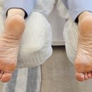 버거킹 경기광주태전점 | 경기광주 발톱무좀으로 인한 발각질 관리 푸스케어 경기광주태전점 후기