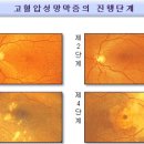 눈속 혈관도 파괴하는 고혈압, 고혈압 망막병증 막으려면? 이미지