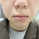 엘앤씨 바이오 리투오 3주차 후기(내돈내산)