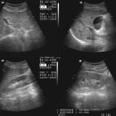 Lt renal cyst 이미지