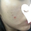 버블세탁전문점 | 반송동피부관리샵 “루스파” 여드름관리 받은 후기👍👍