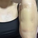 메디캠프 | 수술 흉터커버 (ft. 웨딩촬영)