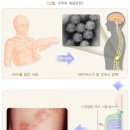 독감(인플루엔자)및특정9대감염병 입원일당(1일이상 30일한도)보장 특별약관 이미지