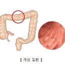 메켈 게실(Meckel&#39;s diverticulum) 소화기 질환이란? 이미지