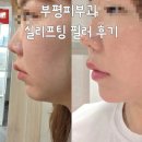 부평피부과 인천실리프팅 내돈내산 효과 통증 전후 실리프팅 필러 후기