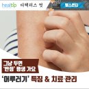 그냥 두면 ‘반점’ 평생 가요 ‘어루러기’ 특징 & 치료‧관리 이미지