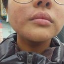 [투병일기] 사이폴엔 2달 먹었고 얼굴을 되찾았습니다°°°
