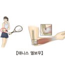 --테니스엘보와 치료이야기 이미지