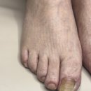 과천 내성 발톱무좀 병원 케어 최고예요