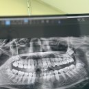 미주치과의원 | 사랑이아프니 홍대, 매복사랑니 발치 후기와 일주일간 식사 기록🦷