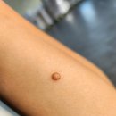 리멤버피부과의원 평택고덕점 | 평택고덕 팔 사마귀 치료 후기 피부과 비용(약혐)