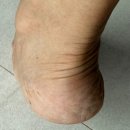 수지구청역 발관리 굳은살제거 발 뒤꿈치 각질제거 찐만족한 레푸스 수지구청점 후기