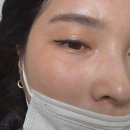 온더뷰티 | 부산기미잡티제거 부산기미제거 온하루뷰티 내돈내산 후기