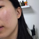 쥬코스메틱 | 손상된 피부 레이저 시술 후 바르는 순한 피부과 재생크림 병원전용 블라쥬 시카좀 크림 후기