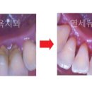 미아동치과 삼양동 치과 연세뉴욕치과-스켈링