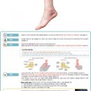 발목의 염좌 및 긴장(Sprain and strain of ankle) 이미지