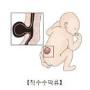 척수수막류[Myelomeningoceles]소아청소년질환 이미지