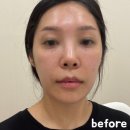 멍투유 | 신논현역 성형외과 강남 실리프팅 효과 업투유 3D 몰딩 메쉬 통증 리얼후기