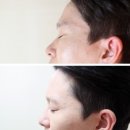 삼오메디 | 강서구 화곡동피부과 - 유메디의원 이마필러후기