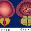 성인 4명중 1명 전립선 비대증..당신은? 이미지