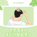 인디자인두피탈모