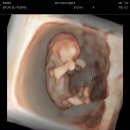 강내안경 | [11-14주차 일상] 13주차 입덧 사라짐..?🙊 임산부 피부과 레이저 치료