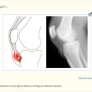 T & B.S 비룡태권도 | 무릎 통증 -오스굿-슐라터병(Osgood-Schlatter disease, OSD) ?