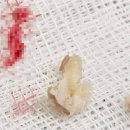 박종태유바외과의원 | [강남] 흉터 없이 깔끔한 핀홀법, P 유바외과 피지 낭종 수술 후기