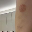 유달리짐 | 💉팔뚝싹주사 | 지방분해주사 | 팔뚝살고민 | 예비신부주사 | 2회차 후기