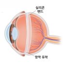 박리 이미지